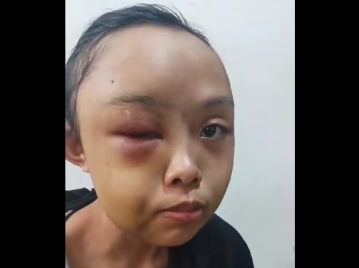 Tak Bersih Cuci Pakaian! Gadis Yatim Piatu di Riau Dianiaya Tante