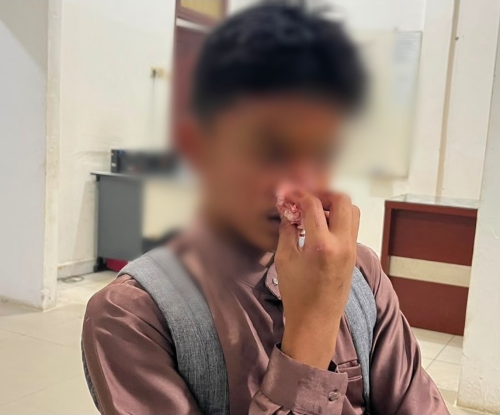 Siswa SMA di Kampar Diduga Dianiaya Kakak Kelas, Hidung Korban Disebut Patah