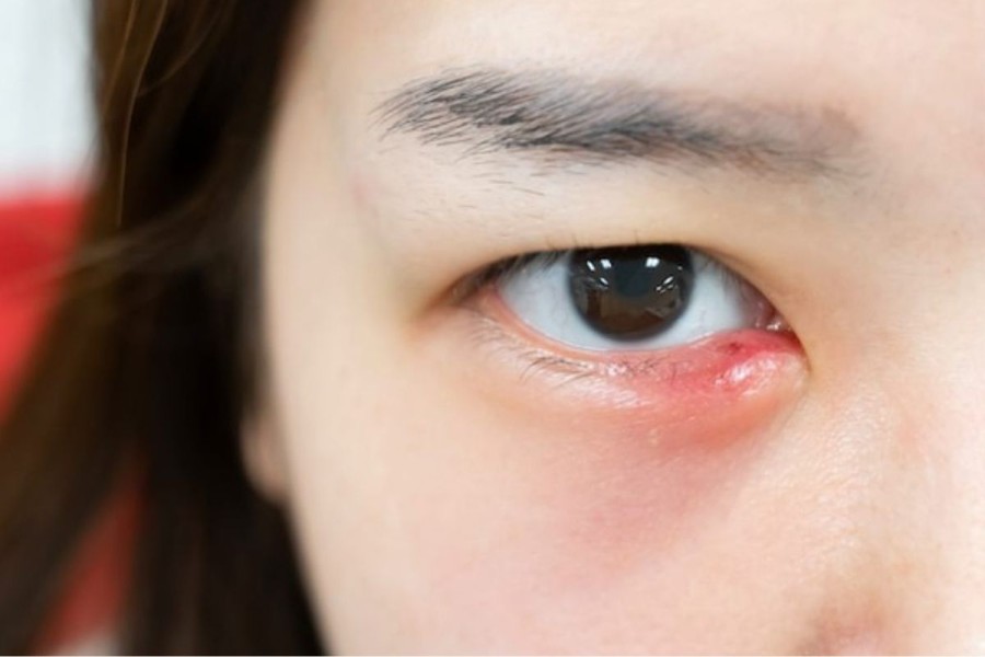 Ini Penyebab dan Cara Mengatasi Kelopak Mata Bawah Bengkak