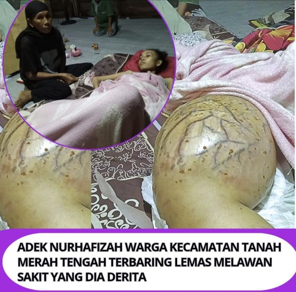 Bertahun-tahun Menderita Pembengkakan Paha, Nurhafiza Warga Desa Tanjung Pasir Inhil Kini Terbaring di Tengah Keterbatasan Biaya Pengobatan