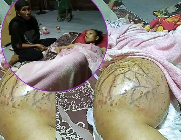 Terbaring Lemah Selama 7 Bulan, Nurhafiza Butuh Bantuan Biaya Pengobatan