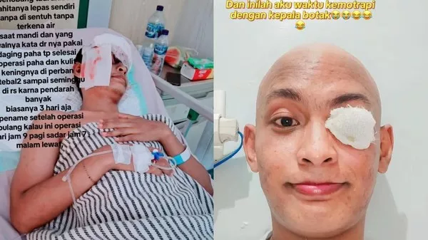 4 Tahun Lawan Kanker Mata Stadium 3, Pria di Medan Harus Kehilangan Bola Mata, Kisahnya Viral dan Bikin Haru!