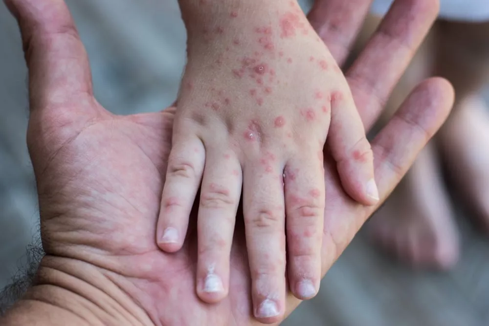 Waspada Campak Jelang Lebaran, Kemenkes Percepat Imunisasi Anak