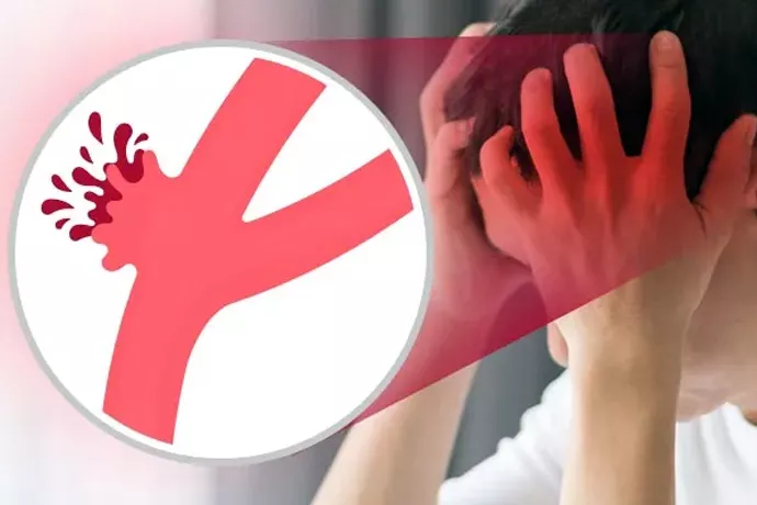 Ini Faktor Risiko Pemicu Strok yang Wajib Dikenali