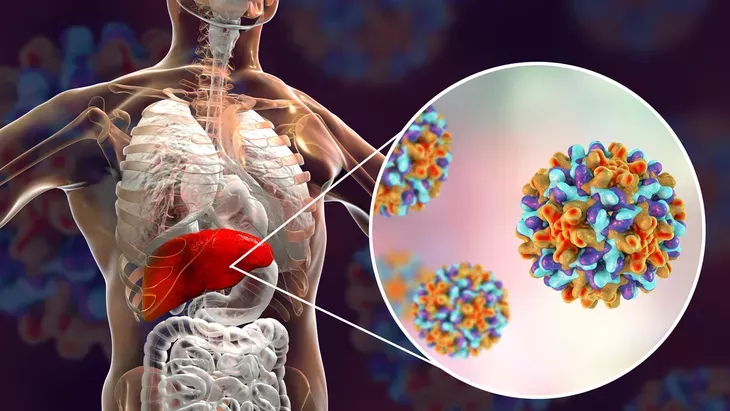 Mengenal Hepatitis: Penyebab, Gejala, dan Cara Mencegahnya