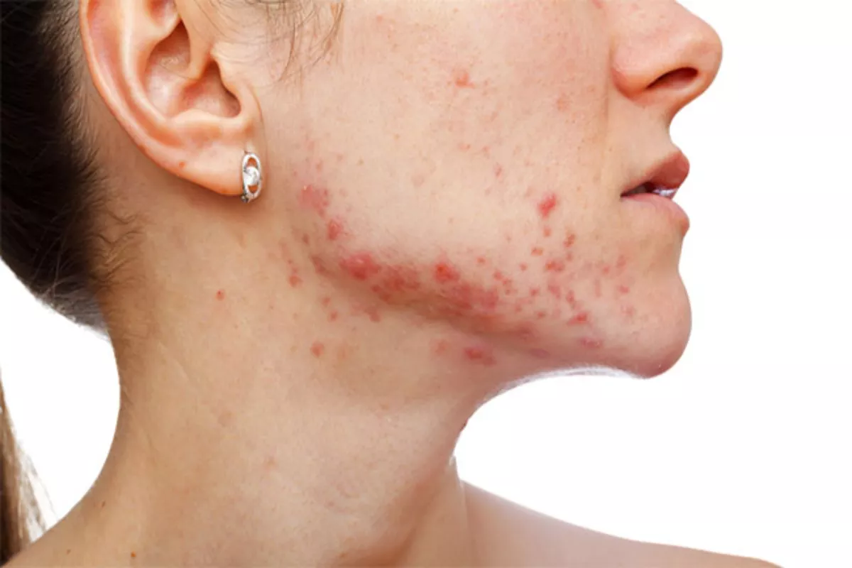Penyebab Jerawat Hormonal vs Jerawat Akibat Lifestyle Lengkap