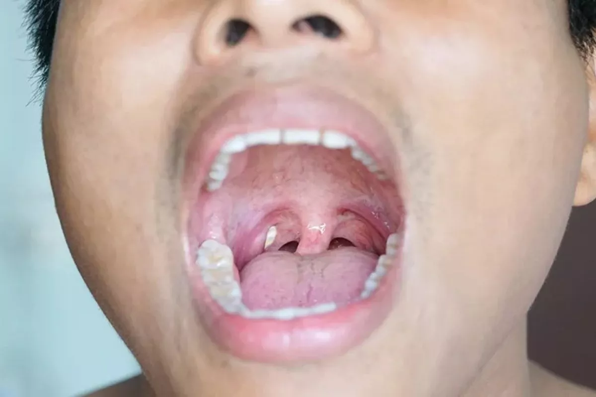 Mengenal Tonsil Stones (Batu Amandel): Penyebab Bau Mulut Menyengat