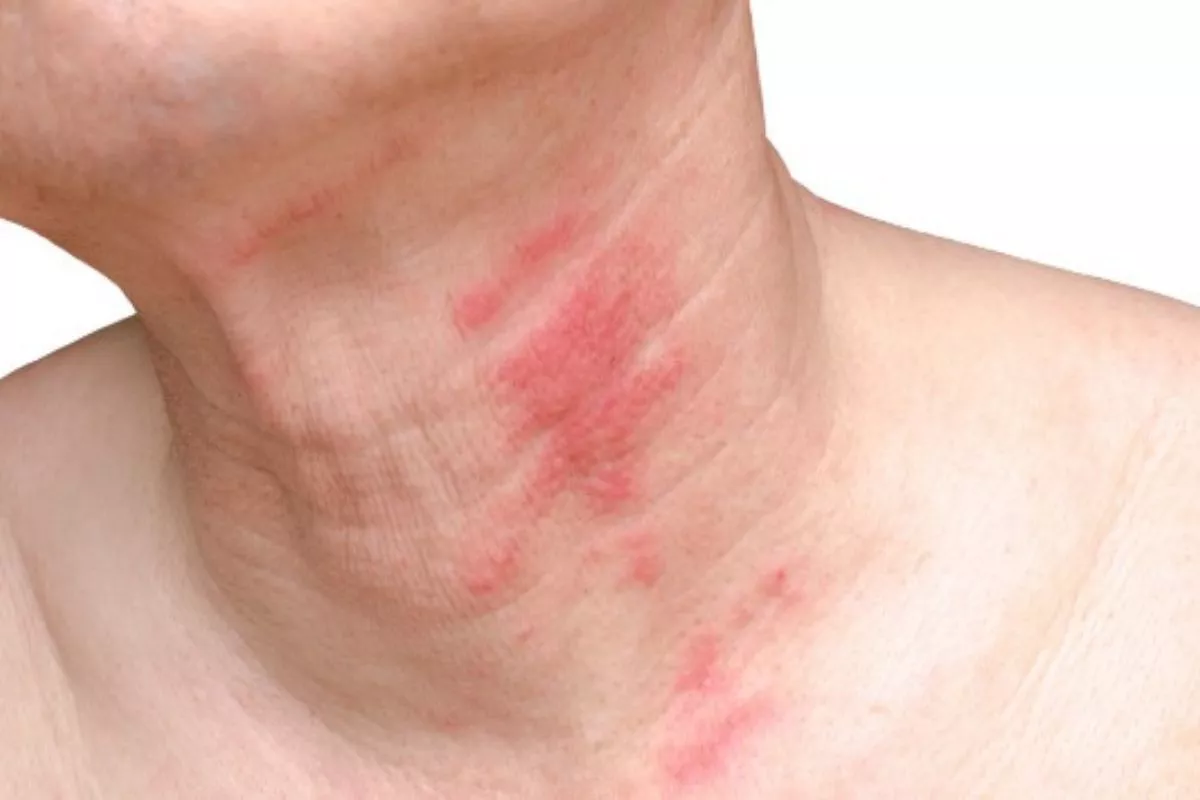Dermatitis: Gejala, Penyebab, dan Cara Mengatasinya