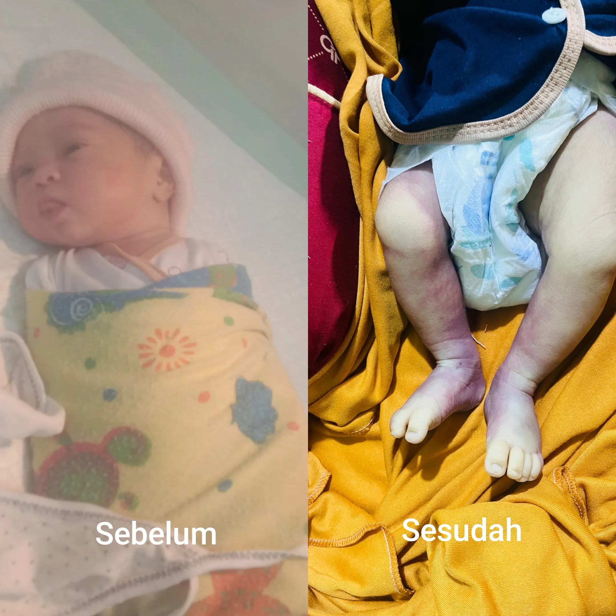 Bayi Lahir Sehat,Disuntik Bengkak Lalu Meninggal