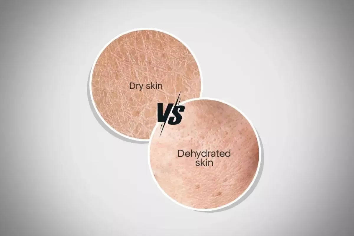 Perbedaan Kulit Kering vs Dehidrasi: Pilih Serum HA atau Ceramide?