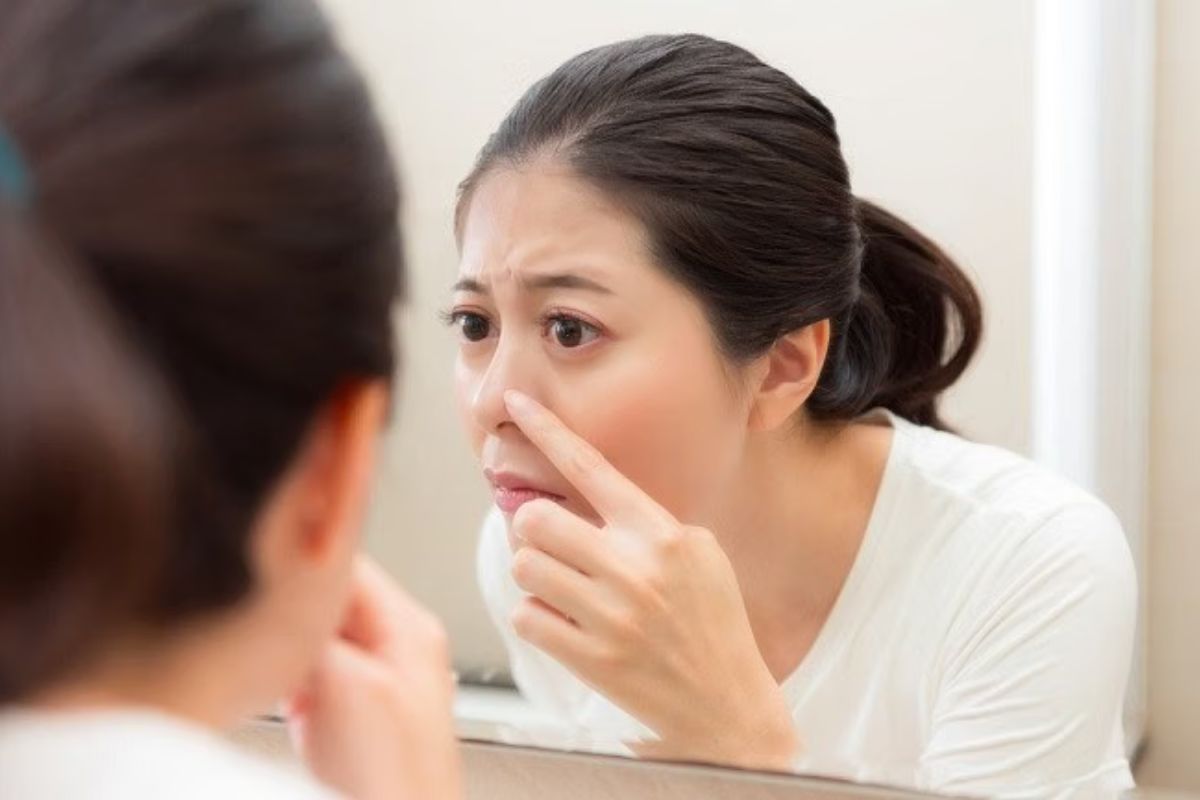 Jangan Asal Pencet, Ini Risiko Jerawat di Bawah Hidung dan Solusinya