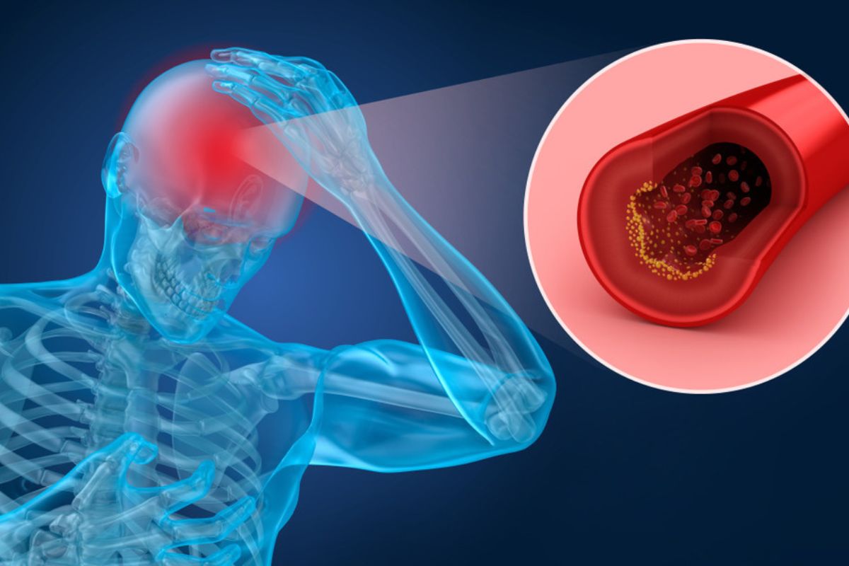 Komplikasi Flu, Anak 11 Tahun Terserang Stroke Iskemik Berat