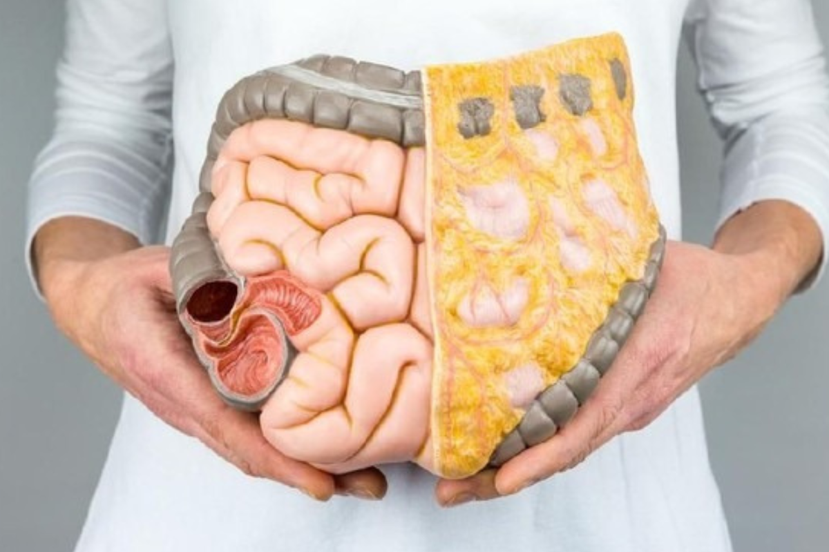 Dokter Ungkap Gejala Awal Kanker Usus Besar pada Wanita Muda