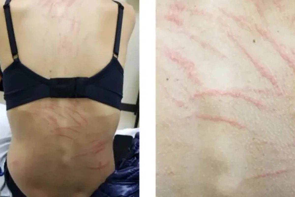 Wanita Alami Ruam Mirip Cambukan Usai Makan Jamur Shiitake