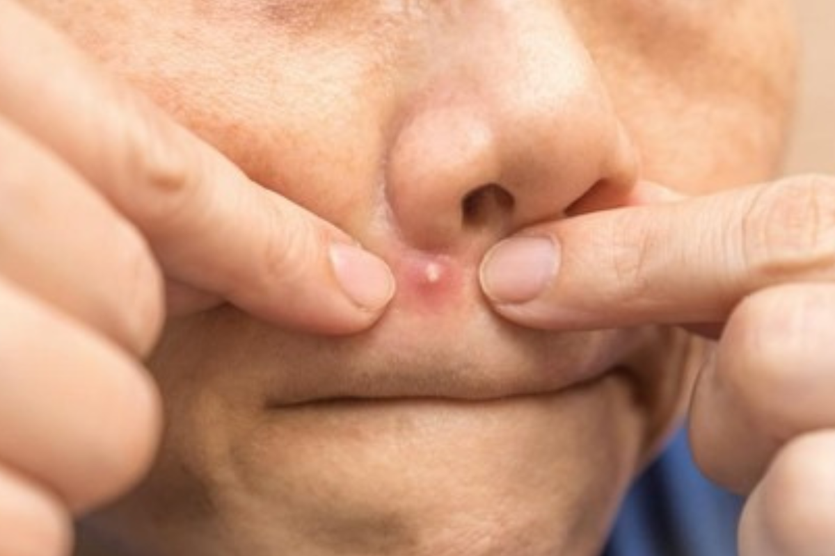 Kenapa Jangan Memencet Jerawat di Bawah Hidung? Ini Alasannya