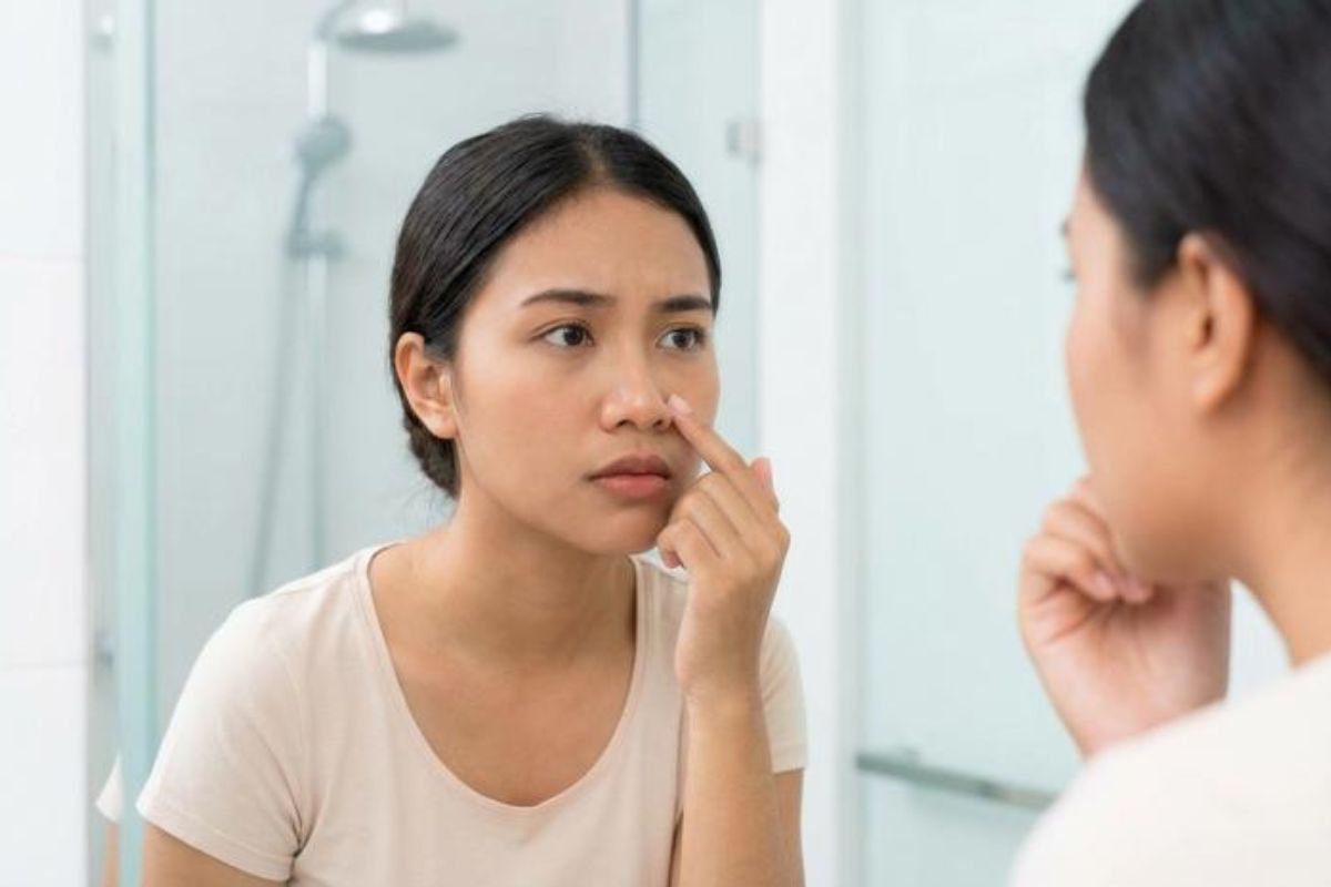 Bahaya Memencet Jerawat di Bawah Hidung dan Cara Amannya