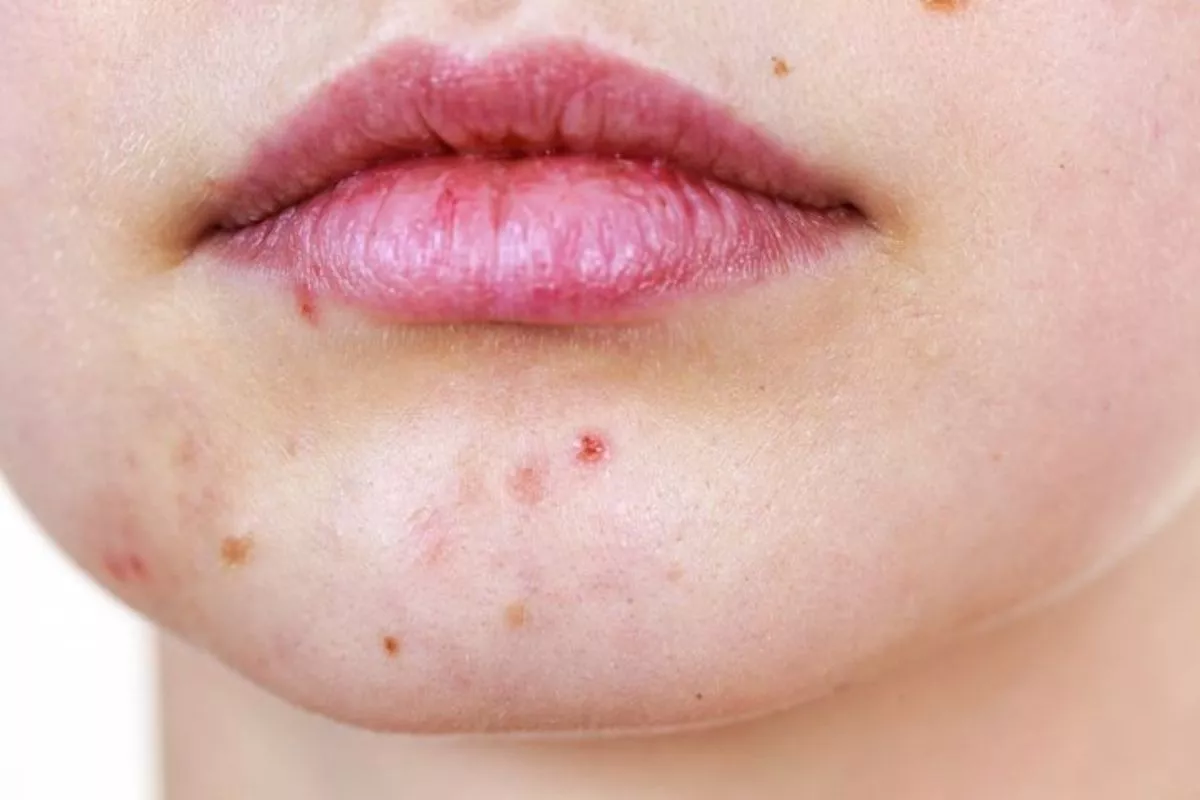 Perbedaan Herpes Bibir dan Sariawan yang Wajib Diketahui