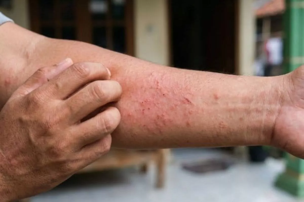 Panduan Orang Tua Menangani Gejala Alergi Susu Sapi pada Anak