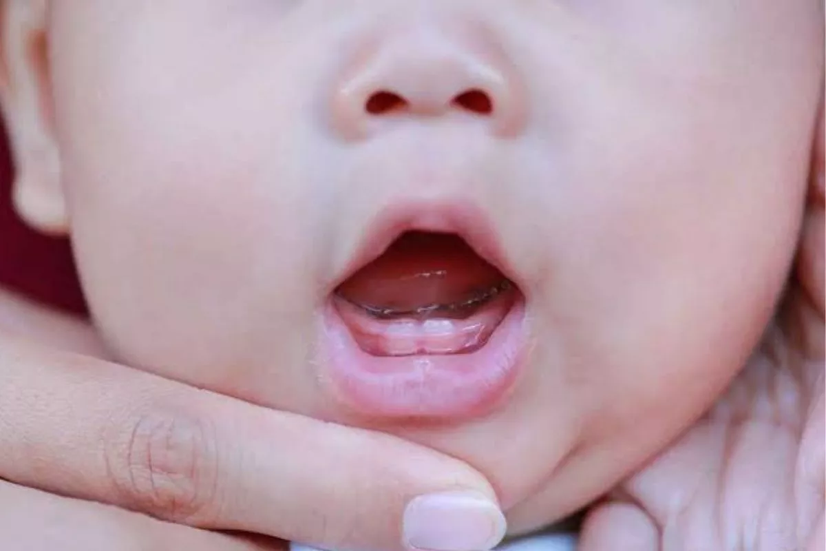 Kenali Batas Usia Normal Tumbuh Gigi Pertama pada Bayi dan Balita