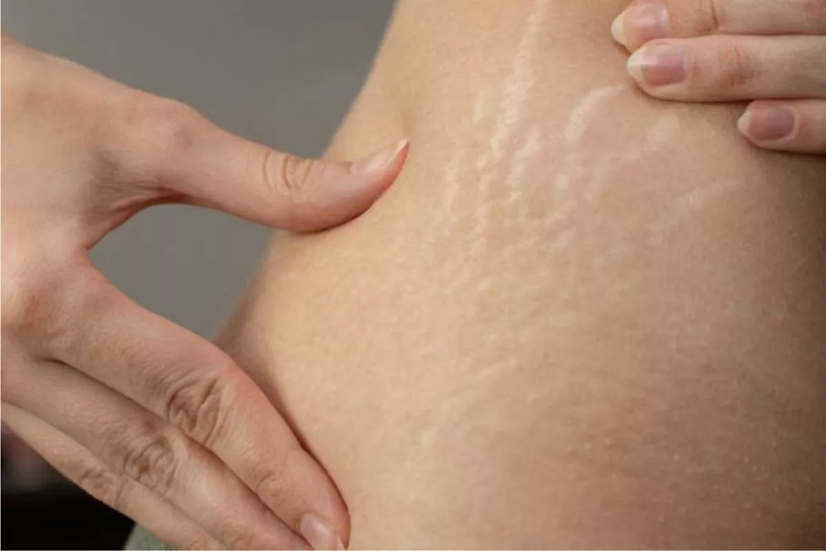 Penyebab Stretch Mark di Pundak dan Cara Mengatasinya