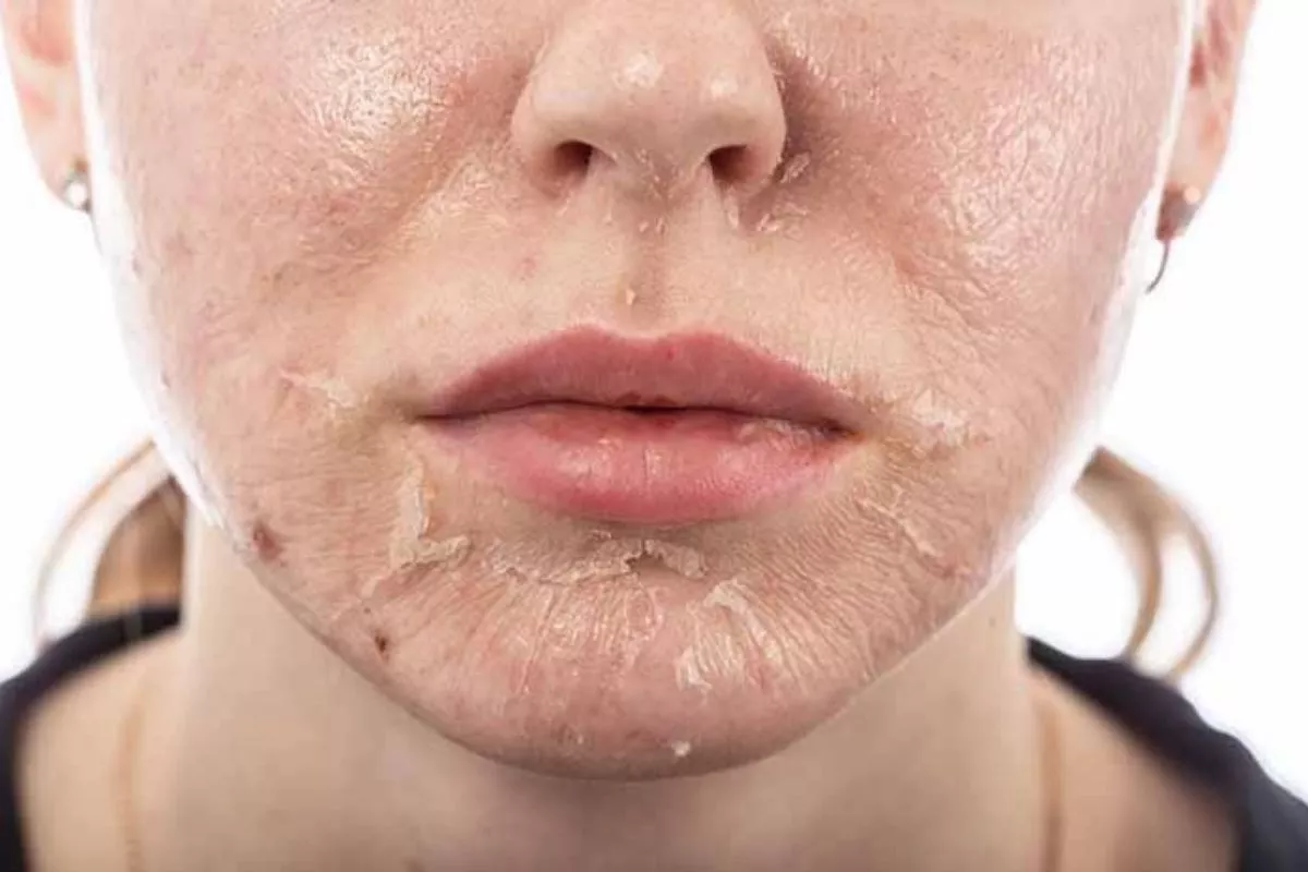 Penjelasan Dokter Soal Larangan Olahraga Setelah Chemical Peeling