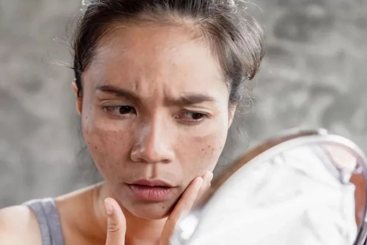 Atasi Jerawat hingga Melasma dengan Kombinasi Teknologi BBL dan MOXI
