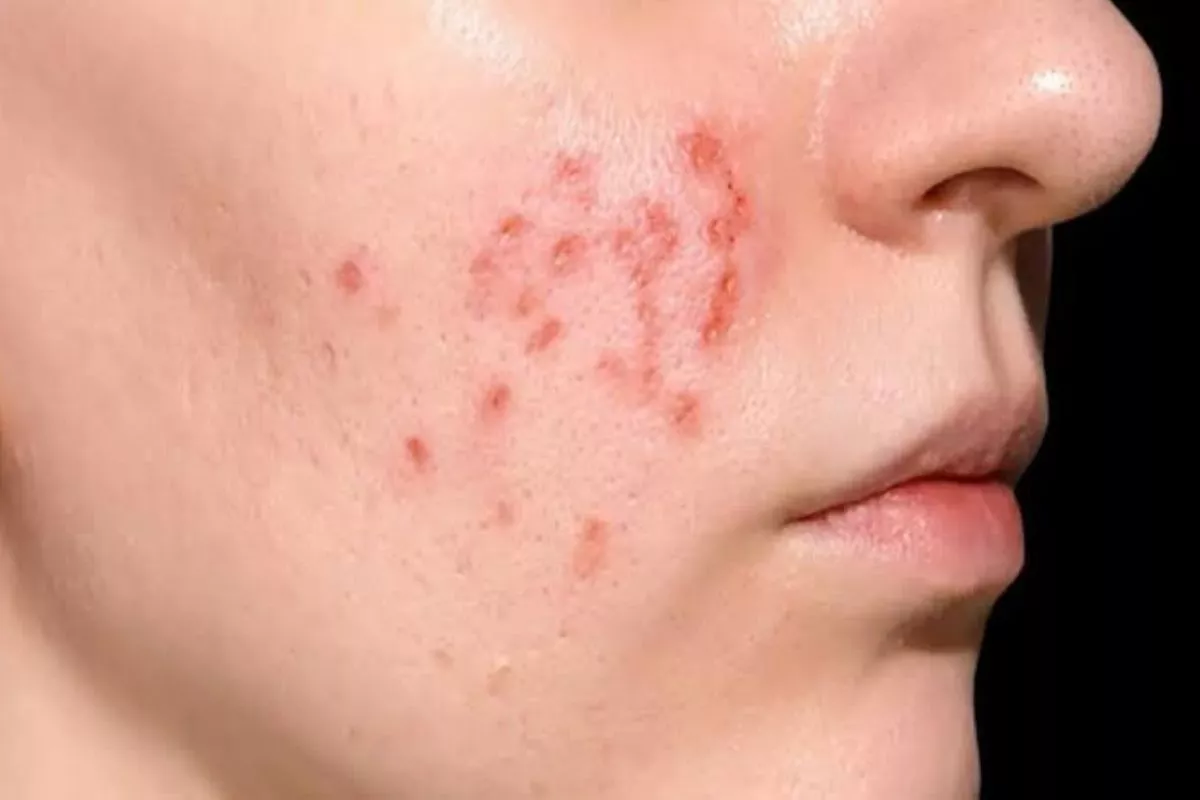 Cara Membedakan Jerawat Hormonal dengan Bakterial pada Wajah