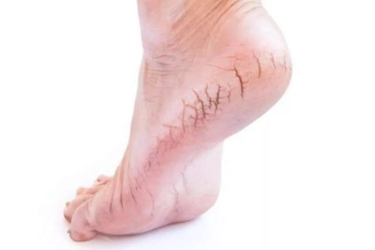 5 Trik Mudah Bikin Kaki Senantiasa Halus Tanpa Masalah Kulit Pecah-pecah