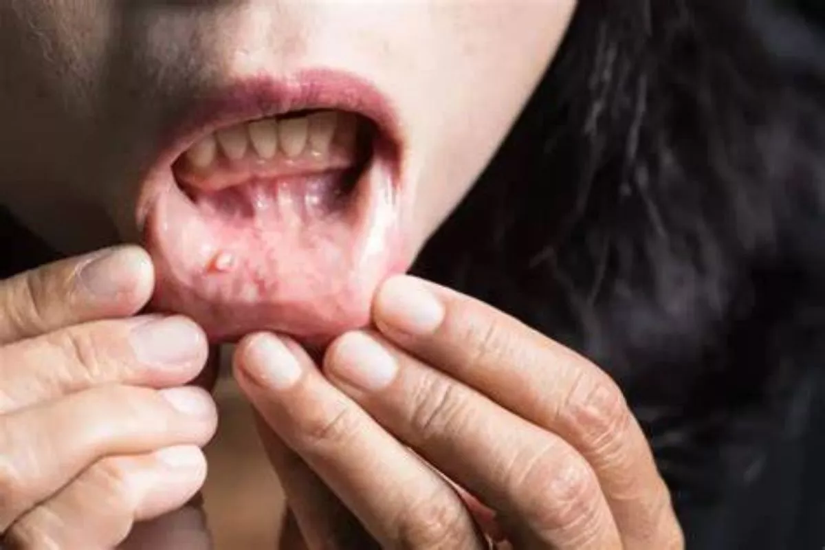 Waspada! Konsumsi Makanan Ini Ternyata Bisa Tingkatkan Risiko Kanker