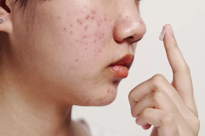 Bekas Jerawat Susah Hilang: Ini Penyebab dan Solusinya Bagi Wajah