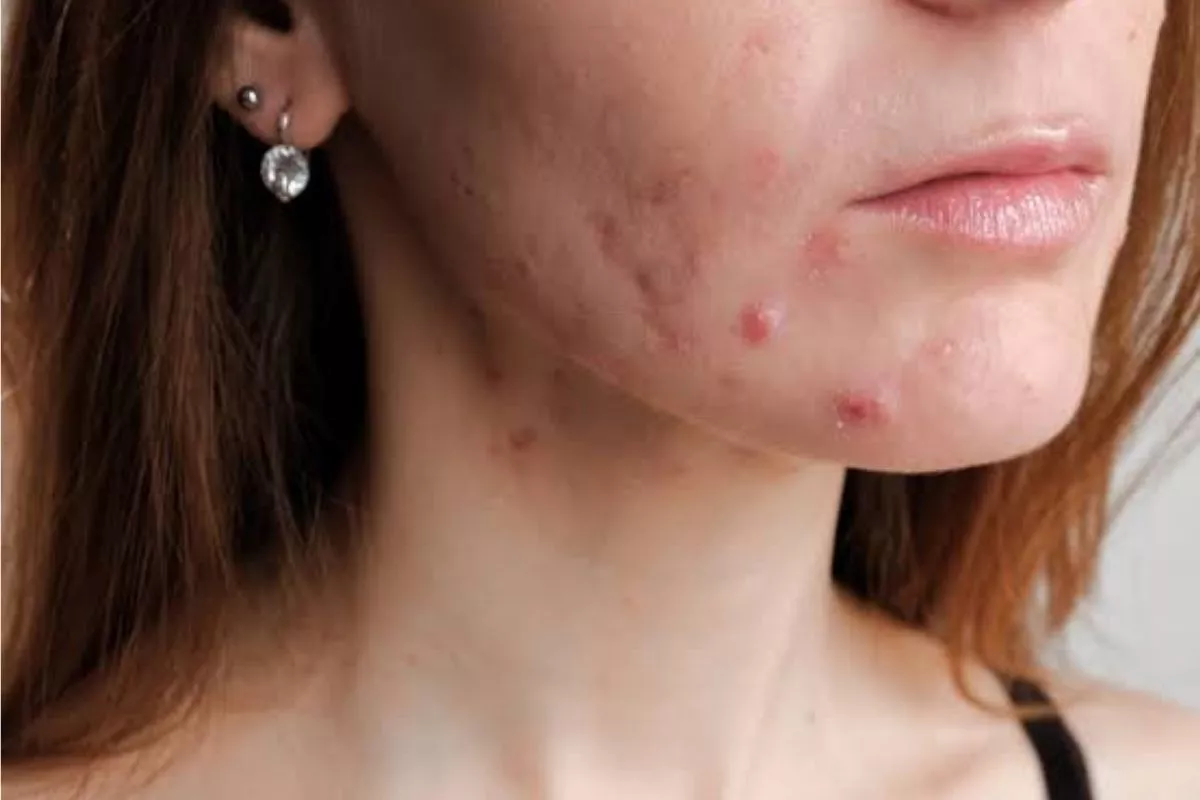 Cara Membedakan Jerawat Hormonal dan Bakterial