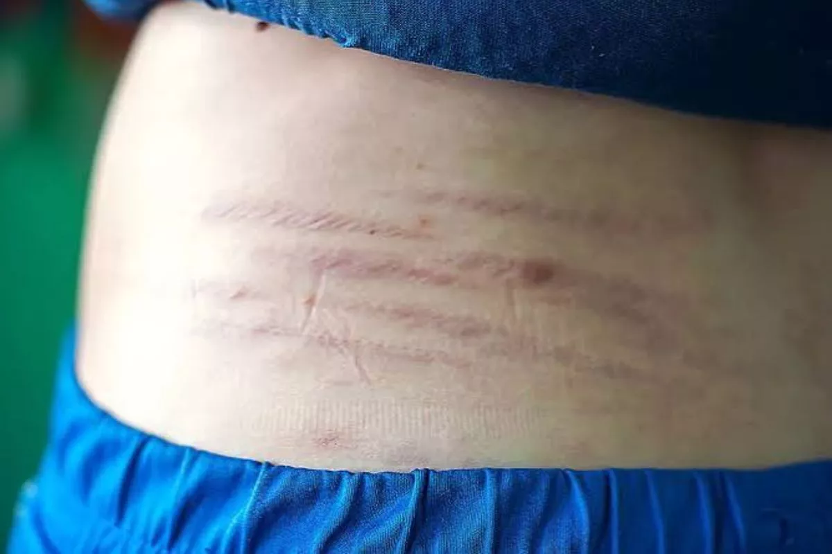 Tak Cuma Bumil, Ini Pemicu Stretch Mark di Pundak dan Solusinya
