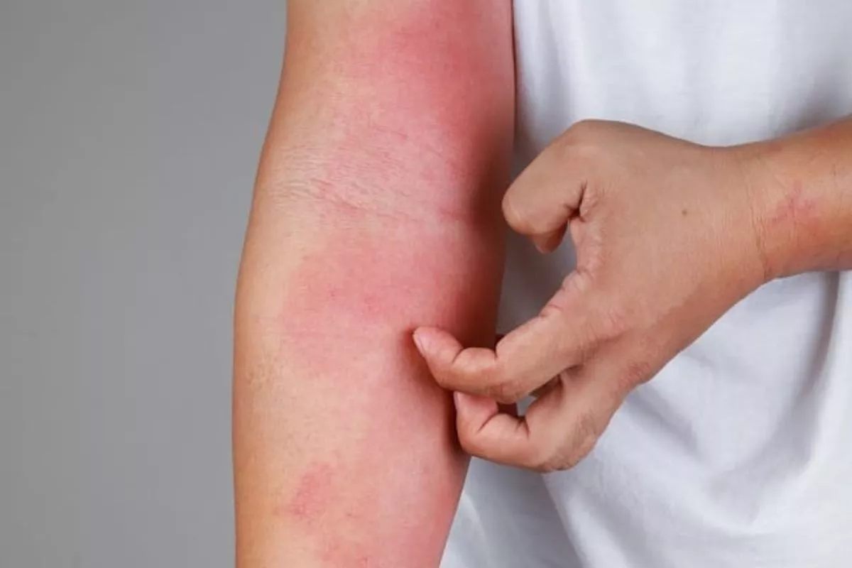 Cara Efektif Mencegah Kekambuhan Dermatitis Atopik Menurut Para Ahli
