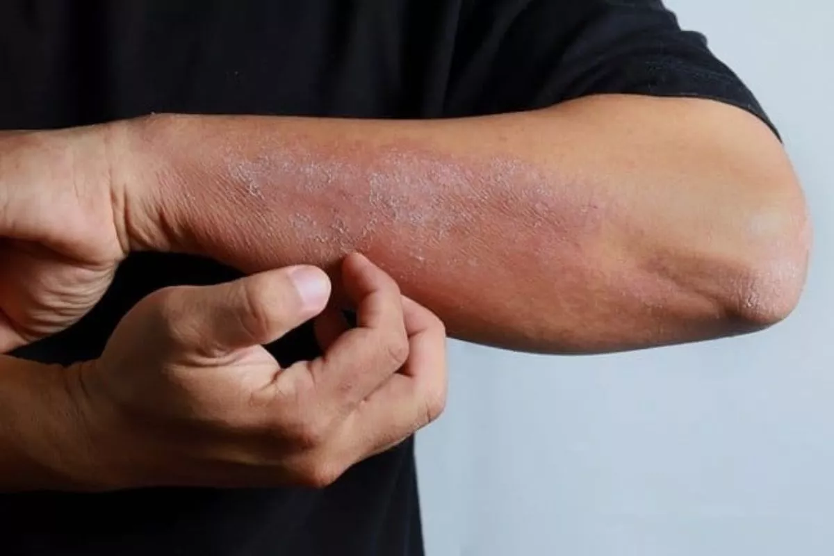 Bukan Hanya Jerawat Ini 5 Tanda Stres Kronis yang Muncul pada Kulit