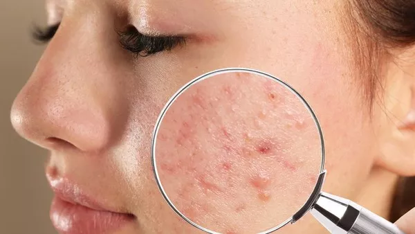 Tips Atasi Jerawat: 5 Rekomendasi Produk Acne Prone Skin