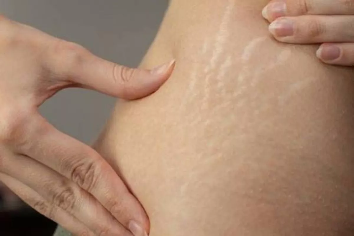 Stretch Mark Muncul di Pundak? Kenali Penyebab dan Cara Mengatasinya