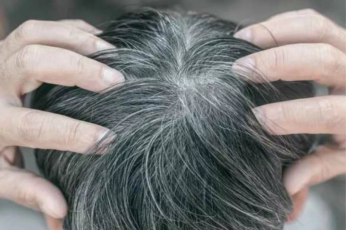 Penyebab Uban Prematur: Genetik, Stres, hingga Defisiensi Nutrisi
