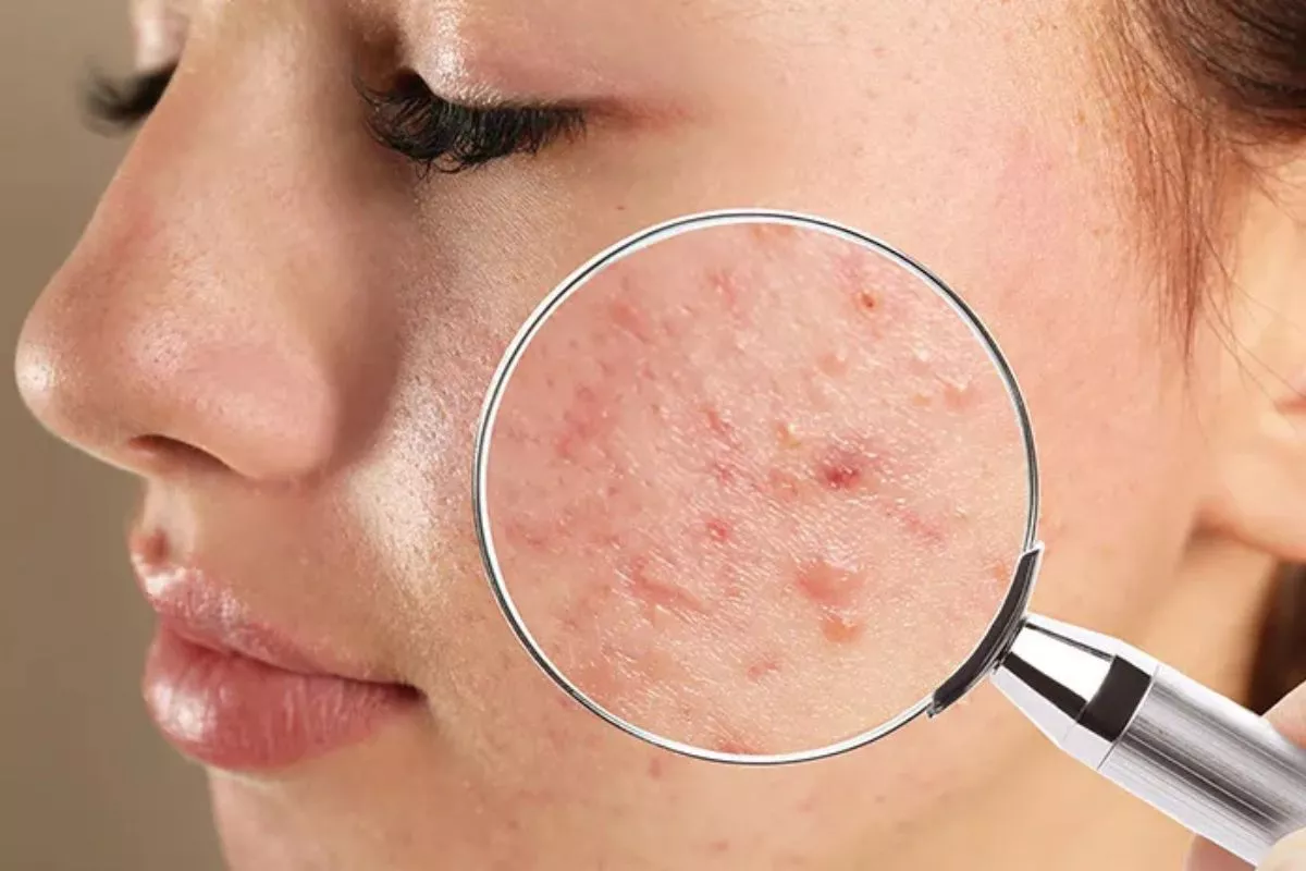 Kenali Perbedaan Ciri Jerawat Stres dengan Jerawat Hormonal