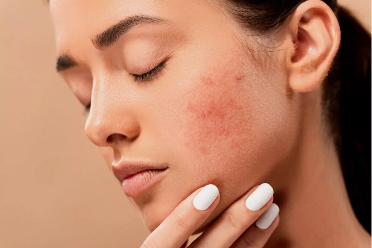 Kesehatan Usus Memengaruhi Jerawat Simak Hubungan Gut Skin Axis