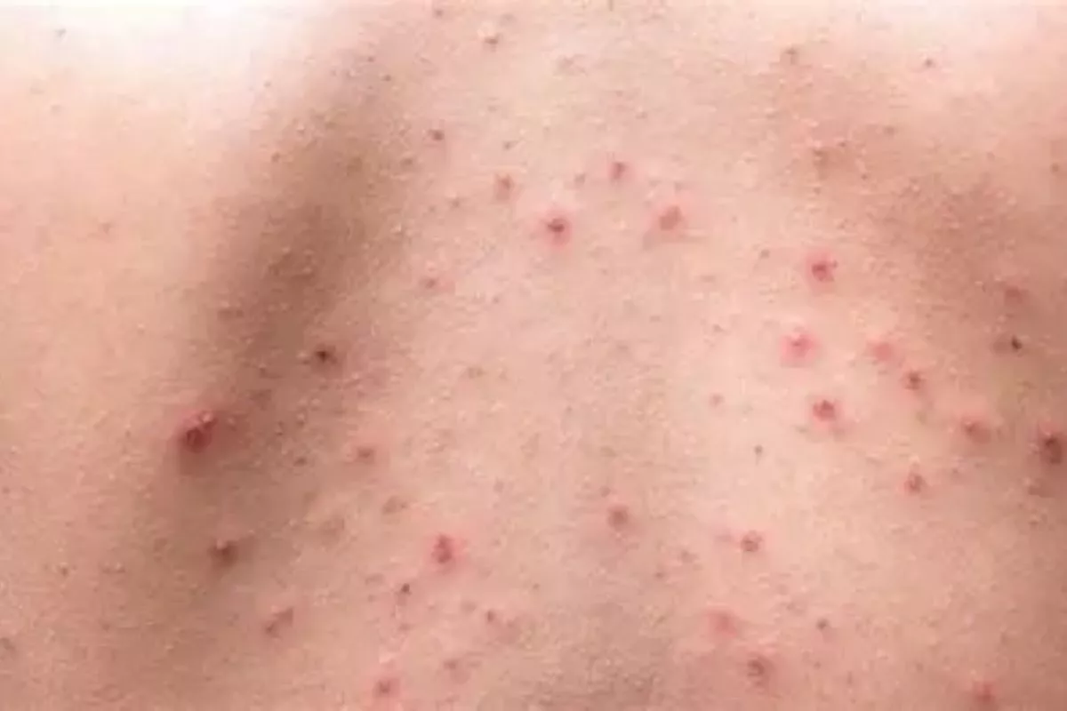 Penyebab Jerawat di Punggung dan Tips Ampuh Mengatasinya