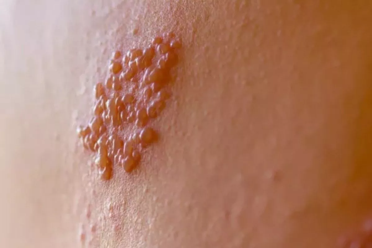 Kenali Ciri Herpes Bibir dan Perbedaannya dengan Sariawan