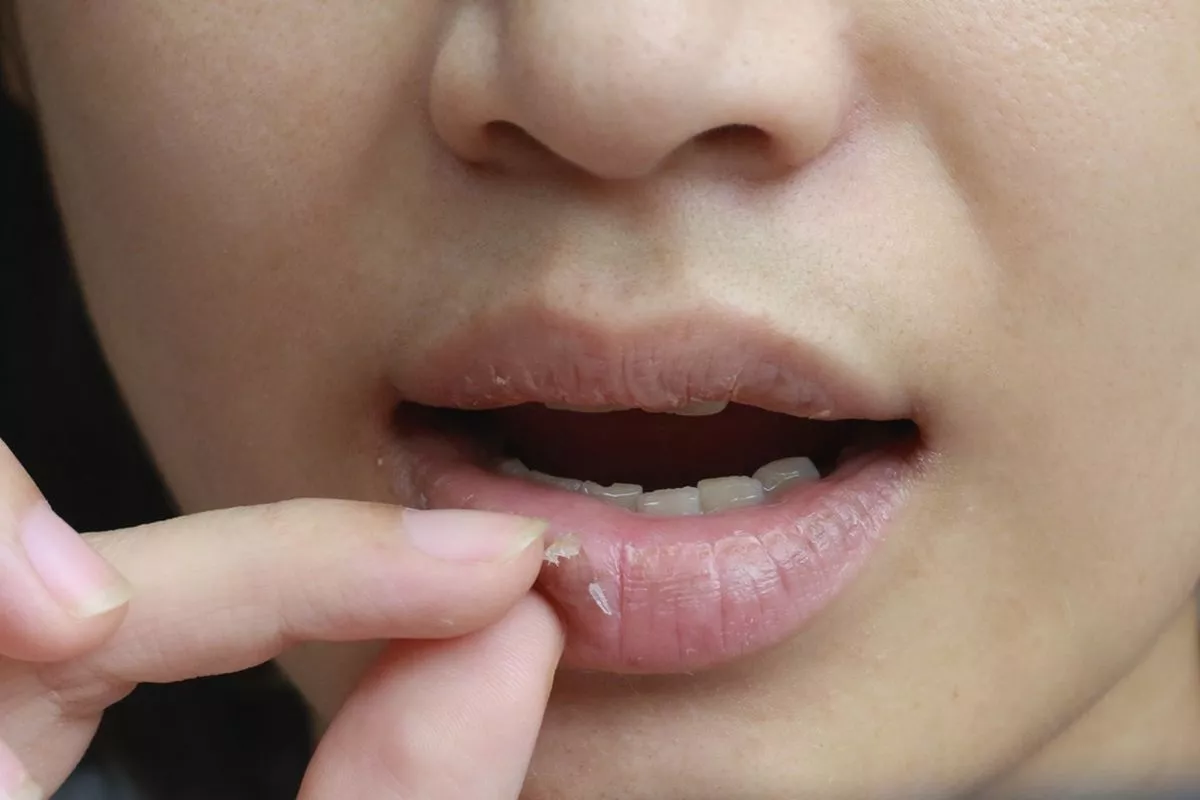 4 Penyebab Utama Bibir Pecah-pecah yang Sering Diabaikan