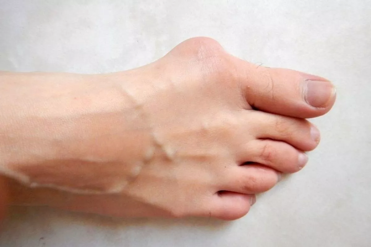 Dokter Ungkap Bunion Bukan Sekadar Masalah Estetika Bentuk Kaki Anda