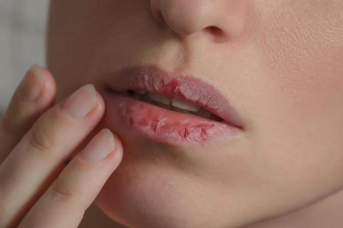 5 Cara Mudah Mencegah Bibir Pecah-Pecah Setiap Hari