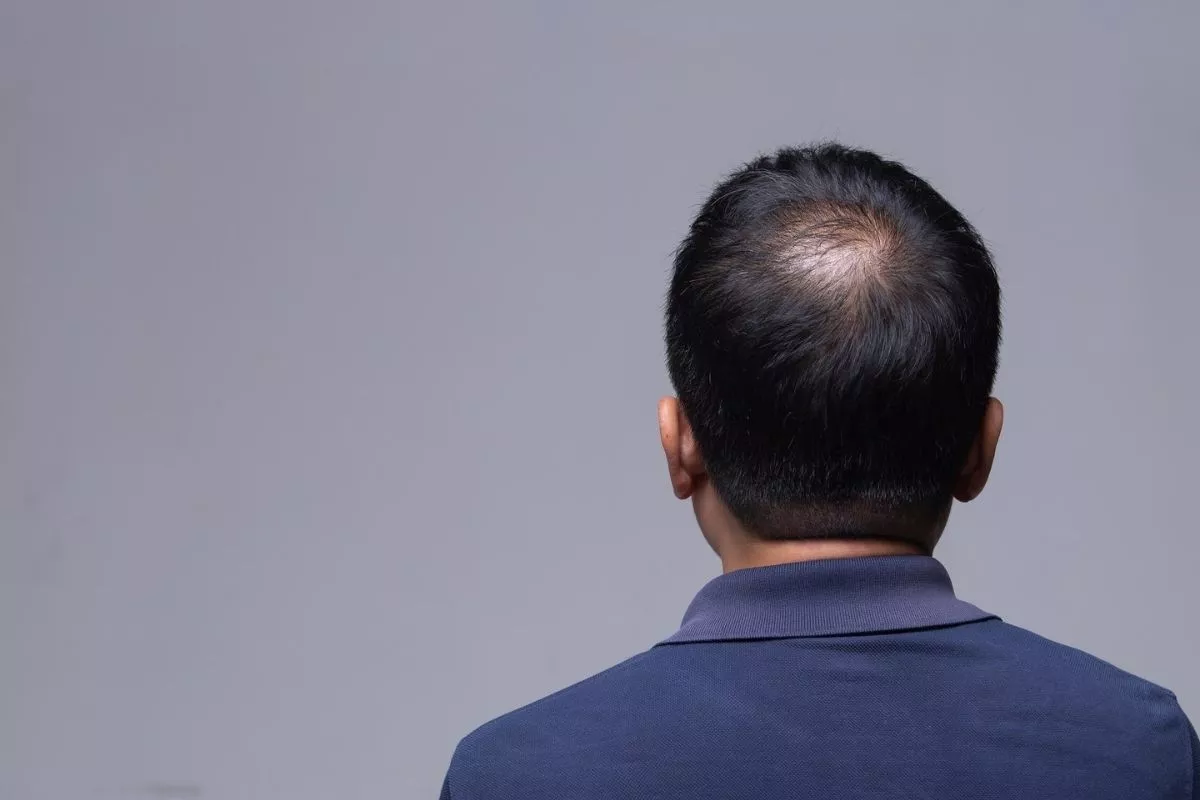 Pria Rentan Alami Kerontokan Rambut Ini 3 Cara Efektif Mengatasinya