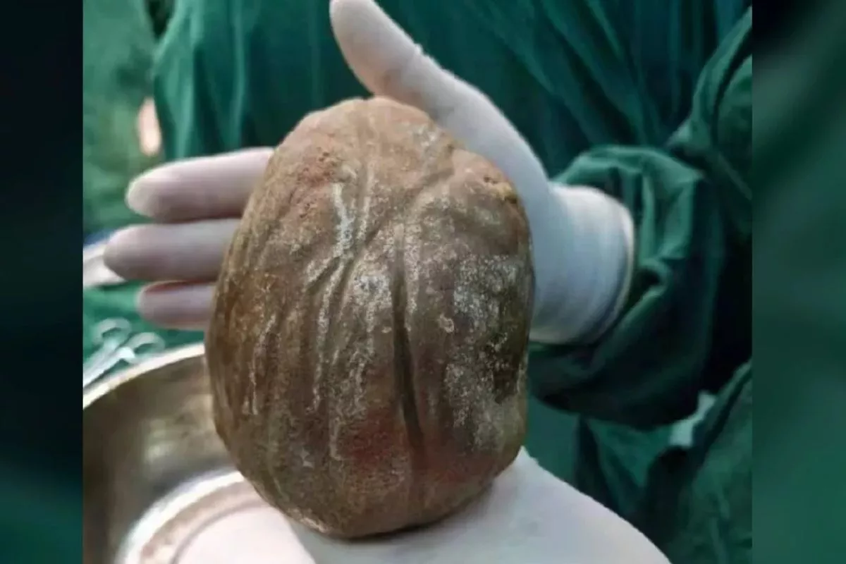 Sering Sulit Kencing, Petani di China Kaget Ada Batu Raksasa 1,3 Kg