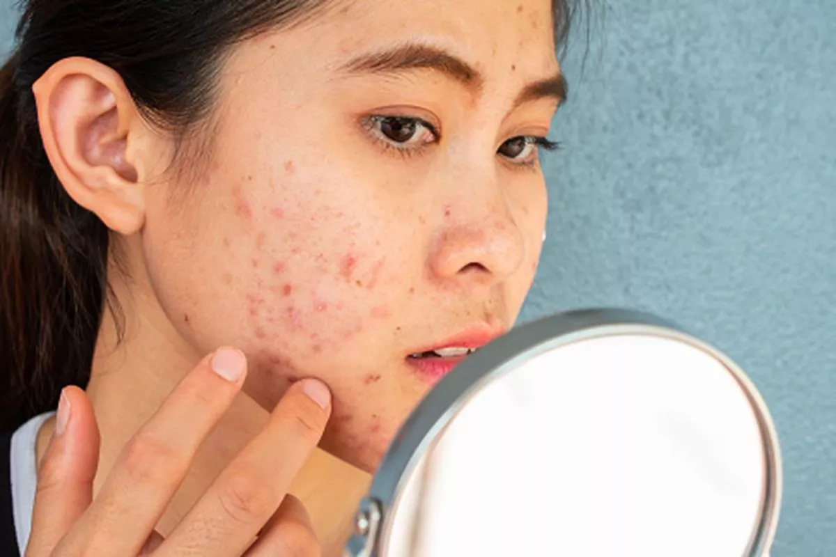 Kenali Tanda Skin Barrier Rusak dan Langkah Mudah Pemulihannya