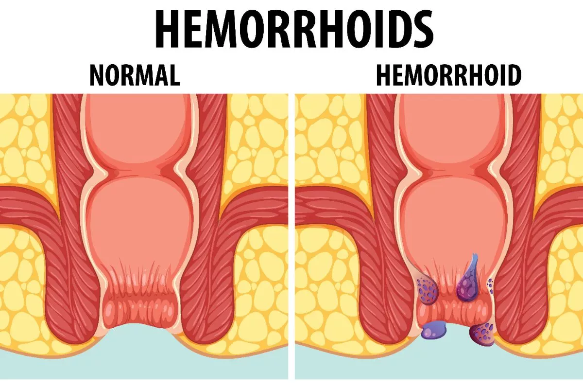 Ambeien Mengganggu Aktivitas? Kenali Laser Hemoroid di RS Azra Bogor