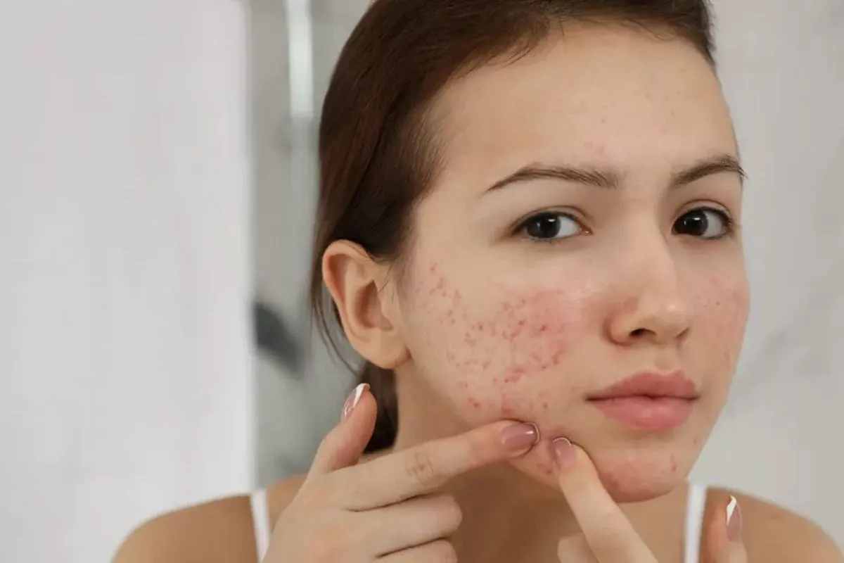 Memahami Perbedaan Purging dan Breakout Akibat Produk Skincare Baru