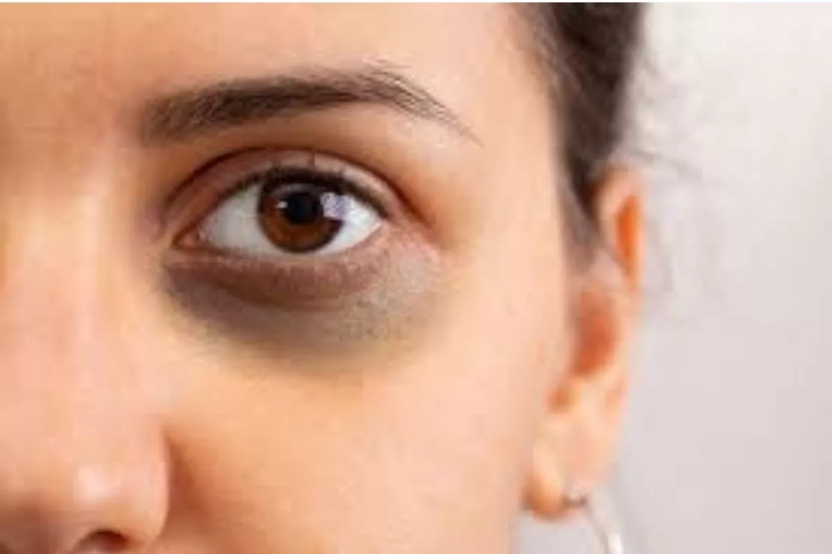 Waspada Raccoon Eyes, Kondisi Lebam Mata Akibat Cedera Kepala